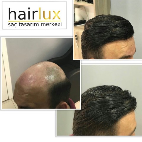 Hairlux Protez Saç Tasarım Merkezi