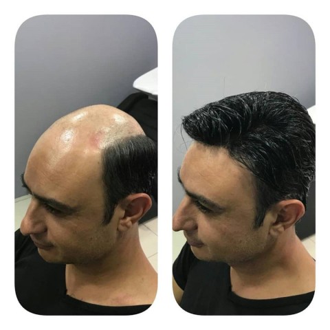 Hairlux Protez Saç Tasarım Merkezi